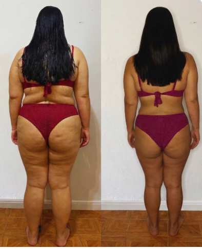 Antes y después espalda